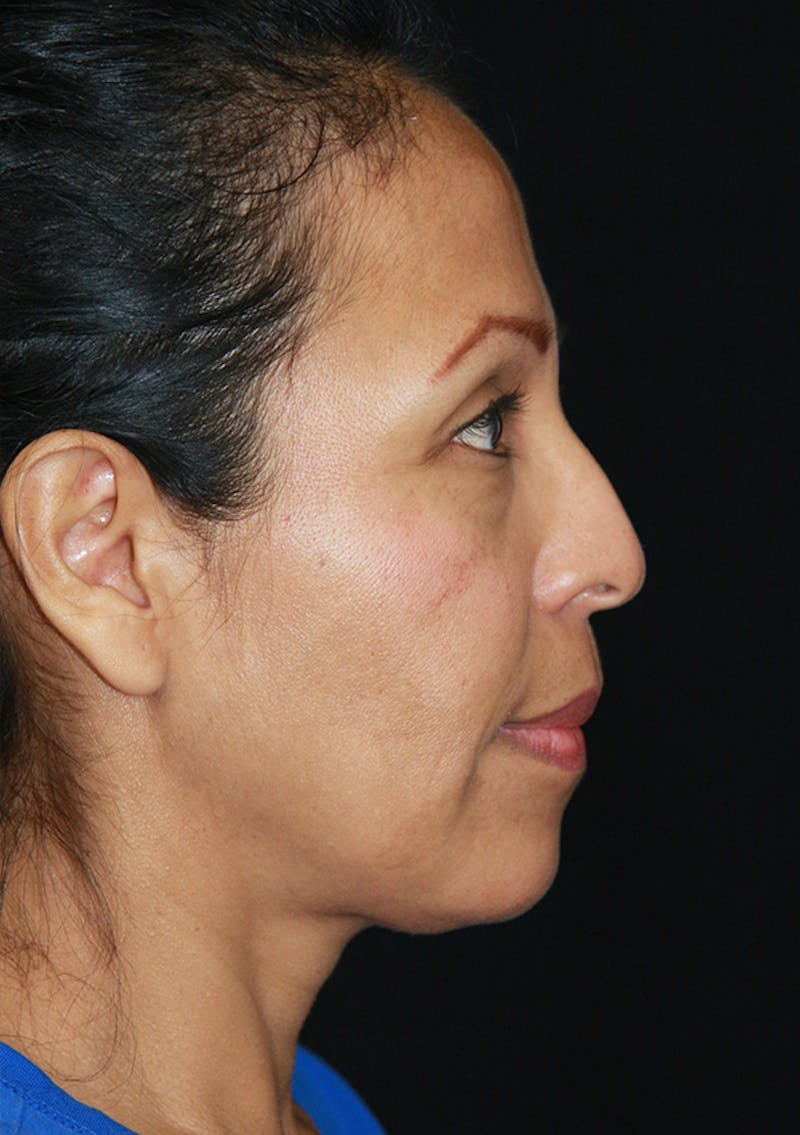 Non-Surgical Rhinoplasty Before & After Gallery - Patient 143521931 - Image 1