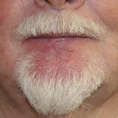 Mohs Reconstruction Before & After Gallery - Patient 143521928 - Image 2