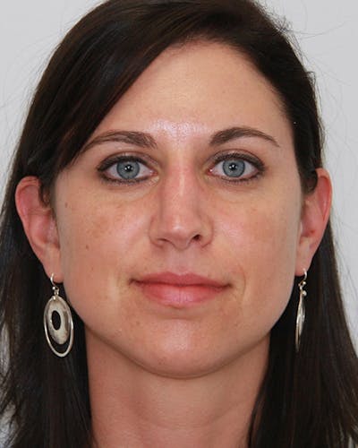 Revision Rhinoplasty Before & After Gallery - Patient 143521935 - Image 1