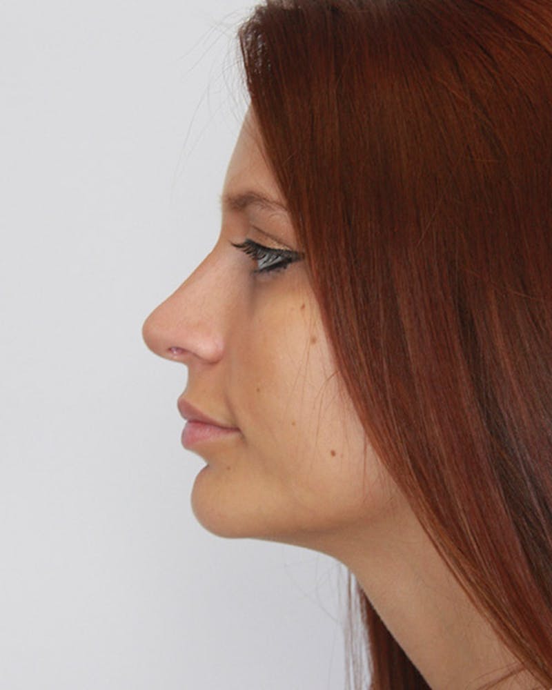 Rhinoplasty Before & After Gallery - Patient 143521929 - Image 10
