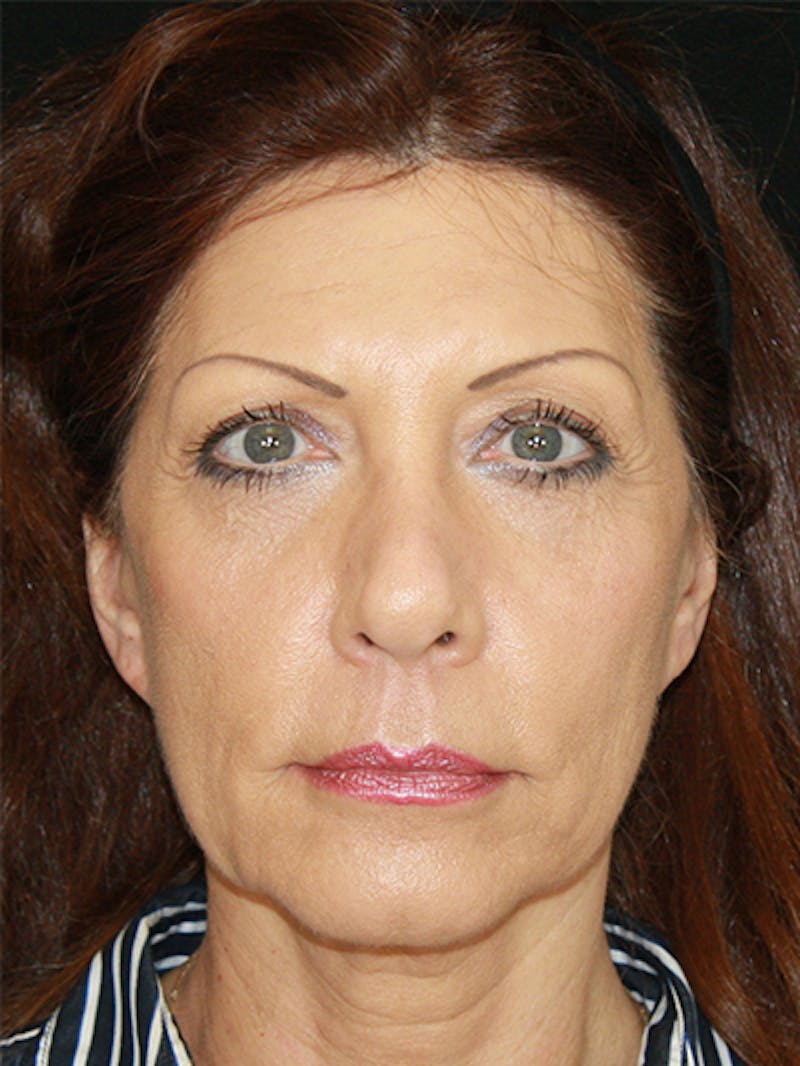 Facelift & Neck Lift Before & After Gallery - Patient 143521936 - Image 1