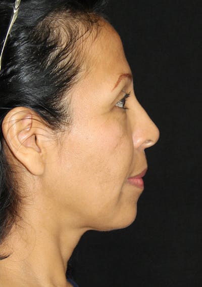 Non-Surgical Rhinoplasty Before & After Gallery - Patient 143521931 - Image 2
