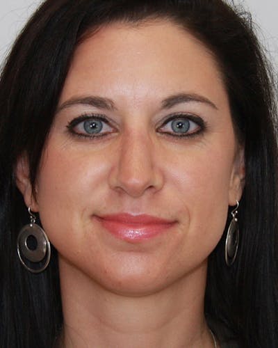 Revision Rhinoplasty Before & After Gallery - Patient 143521935 - Image 2