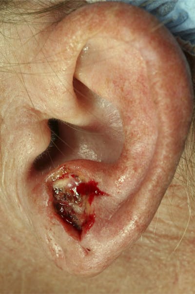 Mohs Reconstruction Before & After Gallery - Patient 143521932 - Image 1