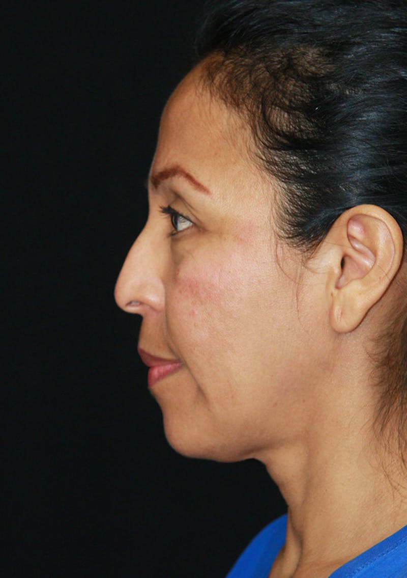 Non-Surgical Rhinoplasty Before & After Gallery - Patient 143521931 - Image 3