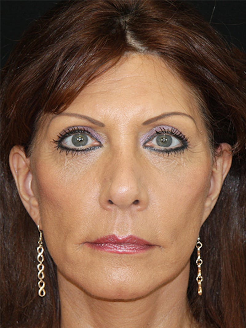Facelift & Neck Lift Before & After Gallery - Patient 143521936 - Image 2