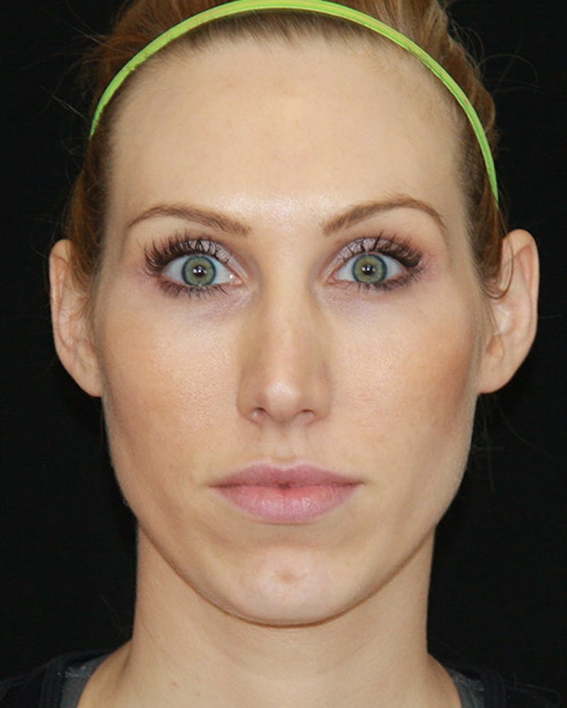 Rhinoplasty Before & After Gallery - Patient 143521940 - Image 1