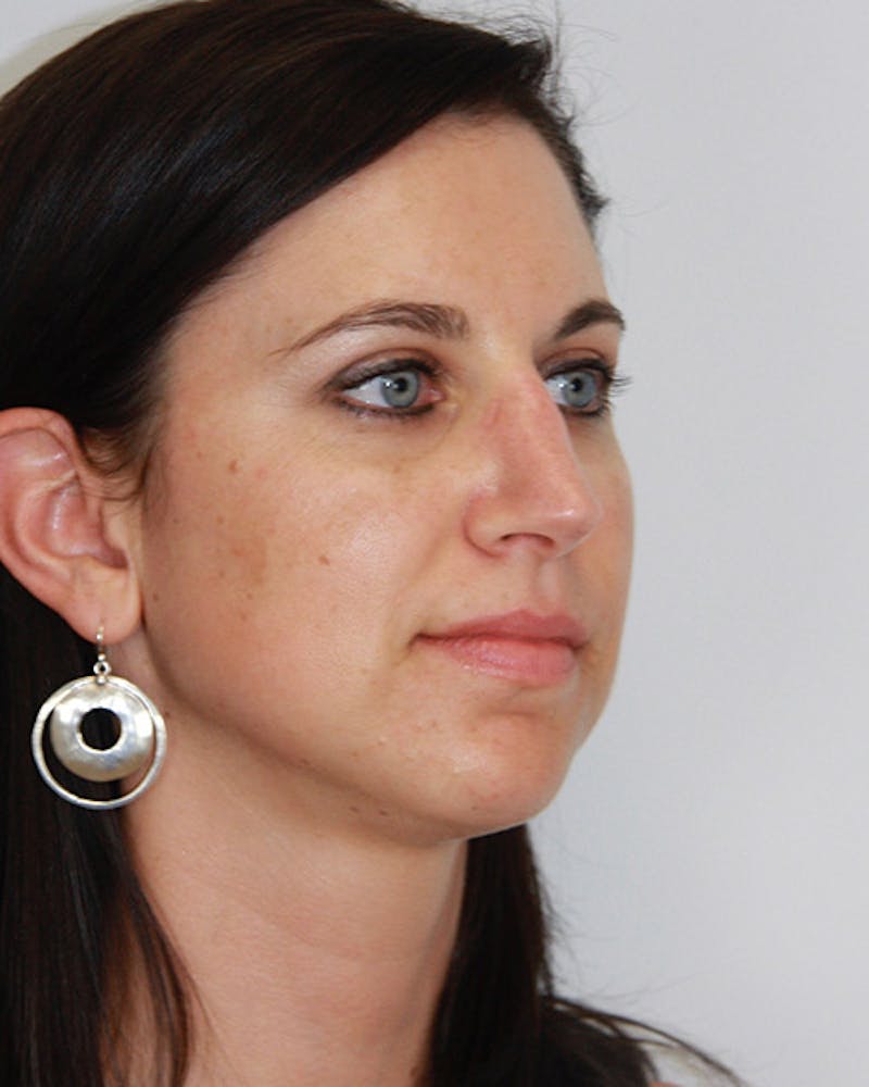 Revision Rhinoplasty Before & After Gallery - Patient 143521935 - Image 3