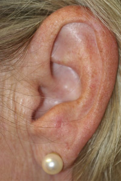 Mohs Reconstruction Before & After Gallery - Patient 143521932 - Image 2