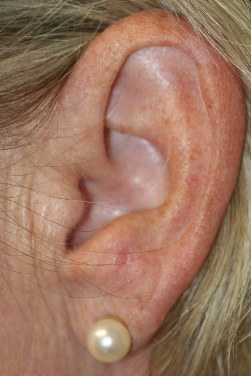 Mohs Reconstruction Before & After Gallery - Patient 143521932 - Image 2