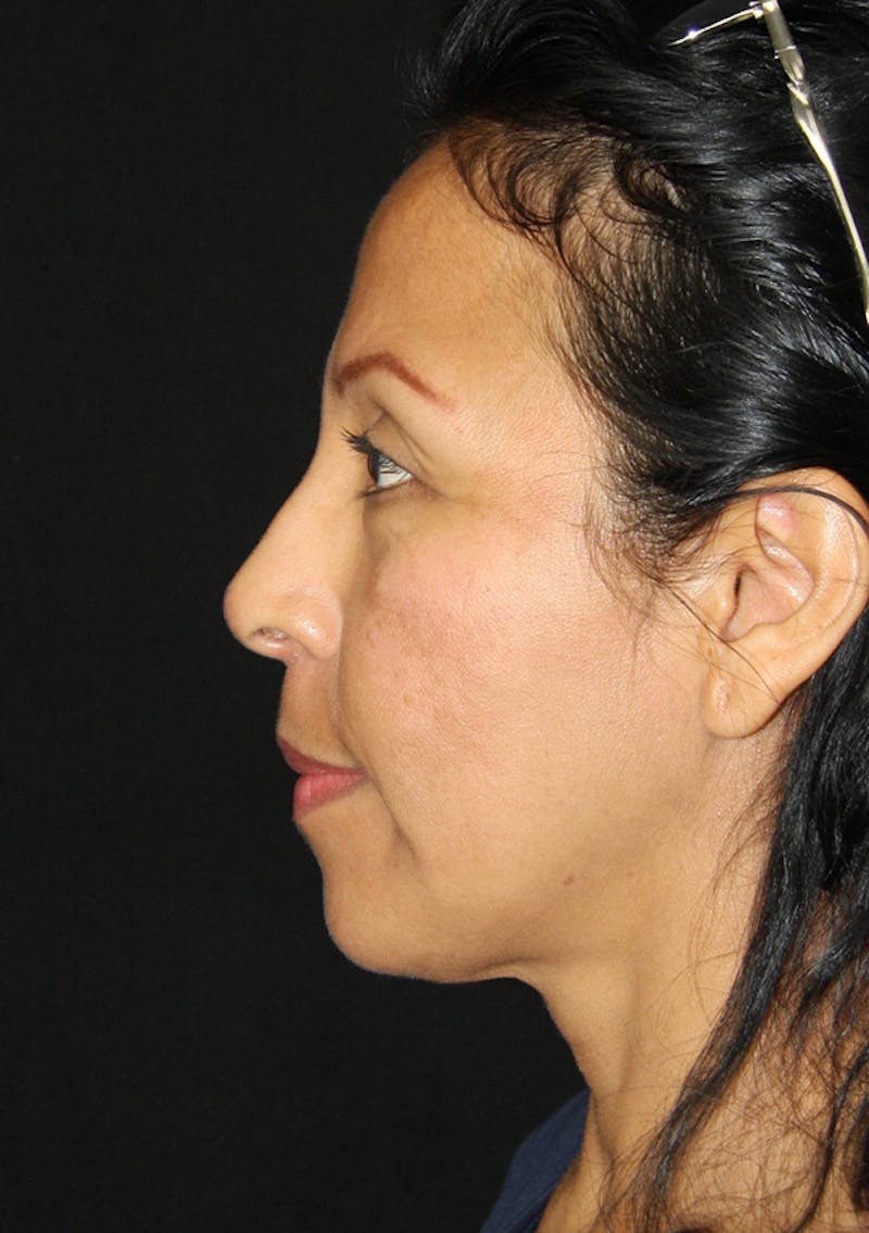 Non-Surgical Rhinoplasty Before & After Gallery - Patient 143521931 - Image 4