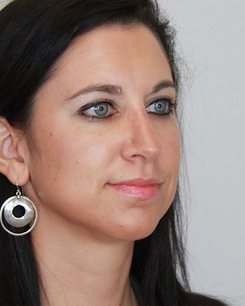 Revision Rhinoplasty Before & After Gallery - Patient 143521935 - Image 4