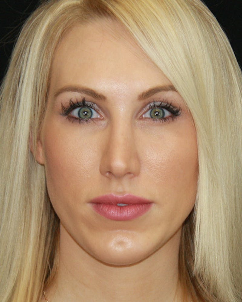 Rhinoplasty Before & After Gallery - Patient 143521940 - Image 2
