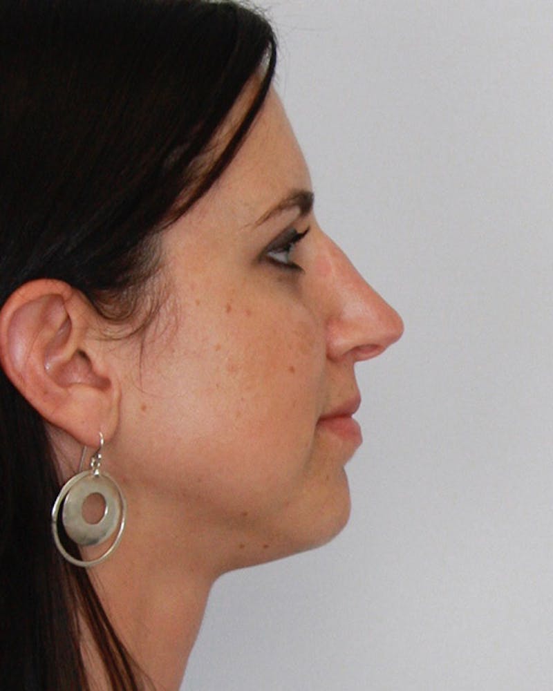 Revision Rhinoplasty Before & After Gallery - Patient 143521935 - Image 5