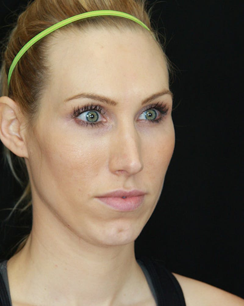 Rhinoplasty Before & After Gallery - Patient 143521940 - Image 3