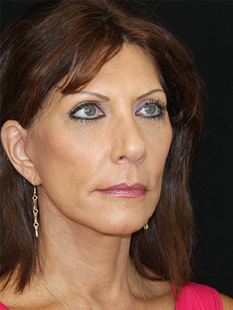 Facelift & Neck Lift Before & After Gallery - Patient 143521936 - Image 4