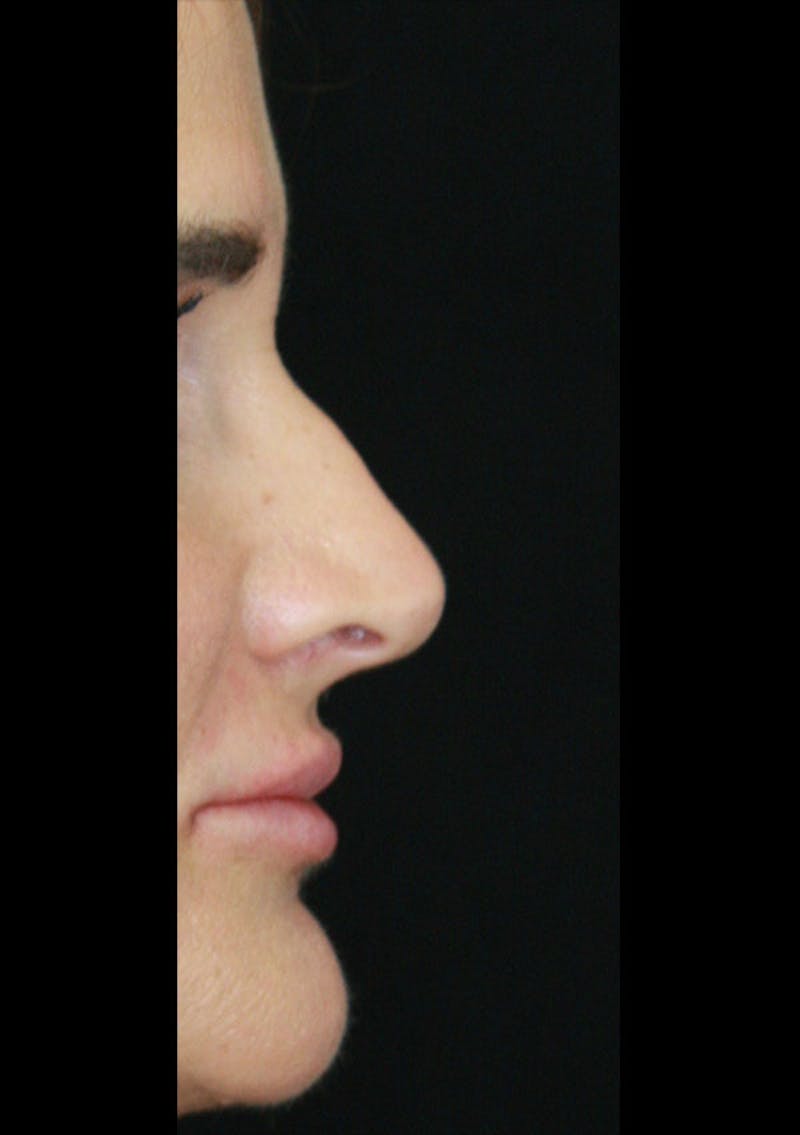 Non-Surgical Rhinoplasty Before & After Gallery - Patient 143521933 - Image 1
