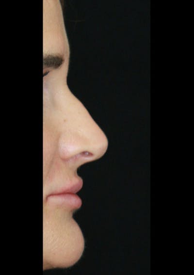 Non-Surgical Rhinoplasty Before & After Gallery - Patient 143521933 - Image 1