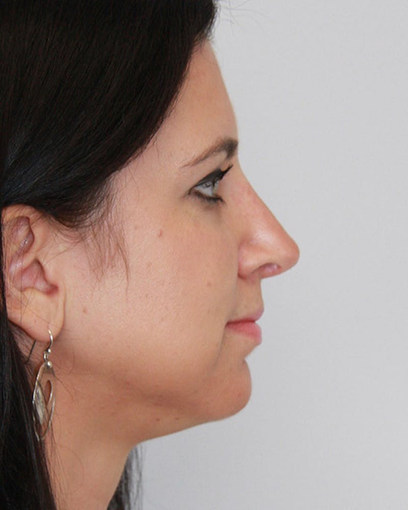 Revision Rhinoplasty Before & After Gallery - Patient 143521935 - Image 6