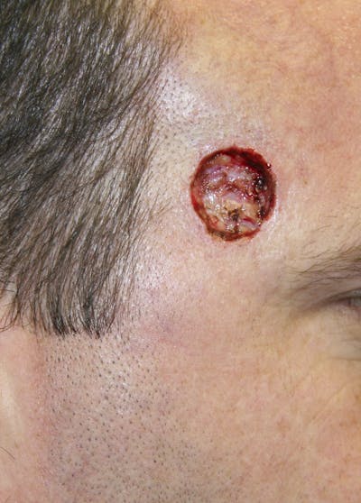 Mohs Reconstruction Before & After Gallery - Patient 143521934 - Image 1