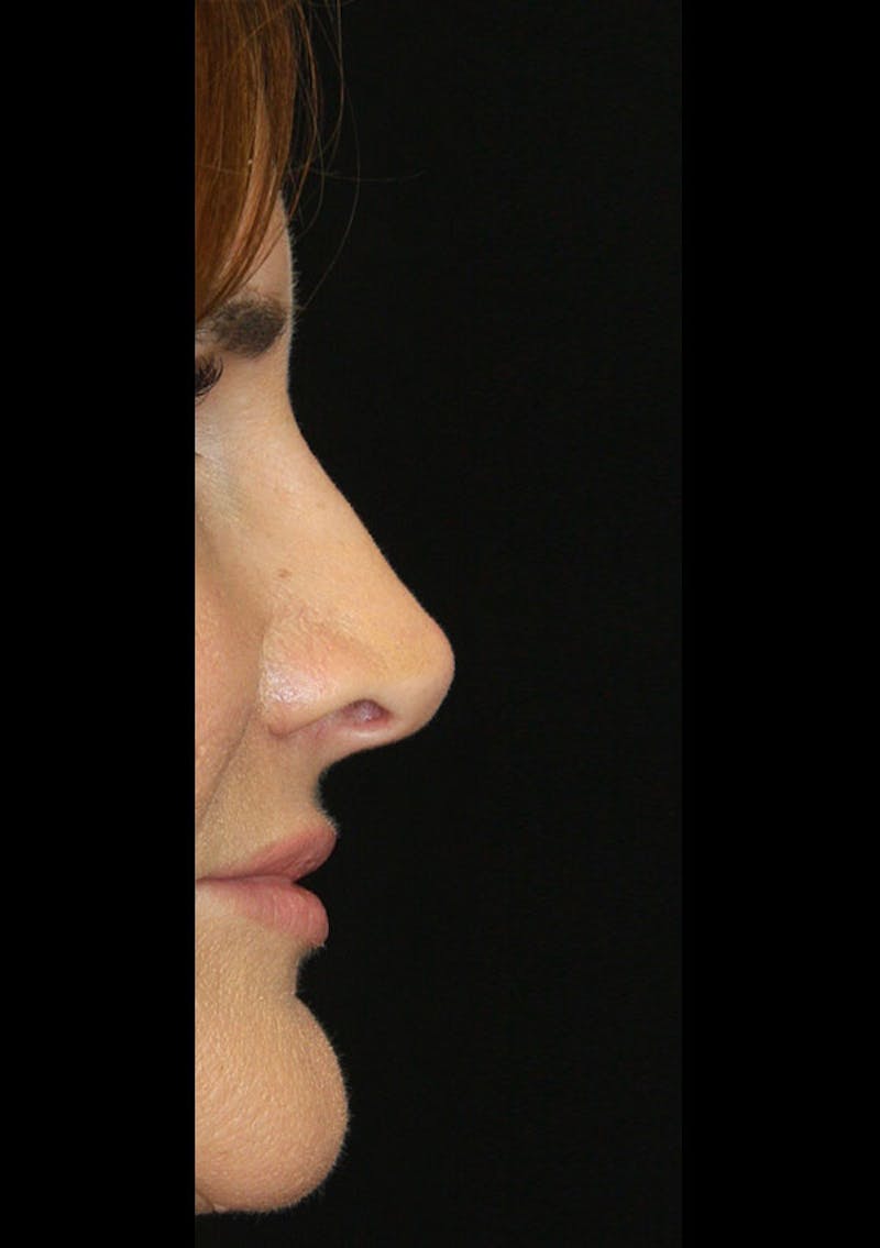 Non-Surgical Rhinoplasty Before & After Gallery - Patient 143521933 - Image 2