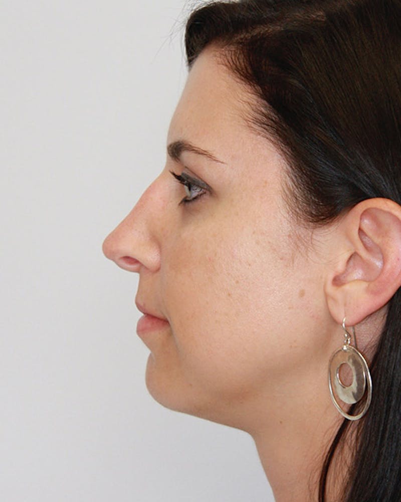 Revision Rhinoplasty Before & After Gallery - Patient 143521935 - Image 7