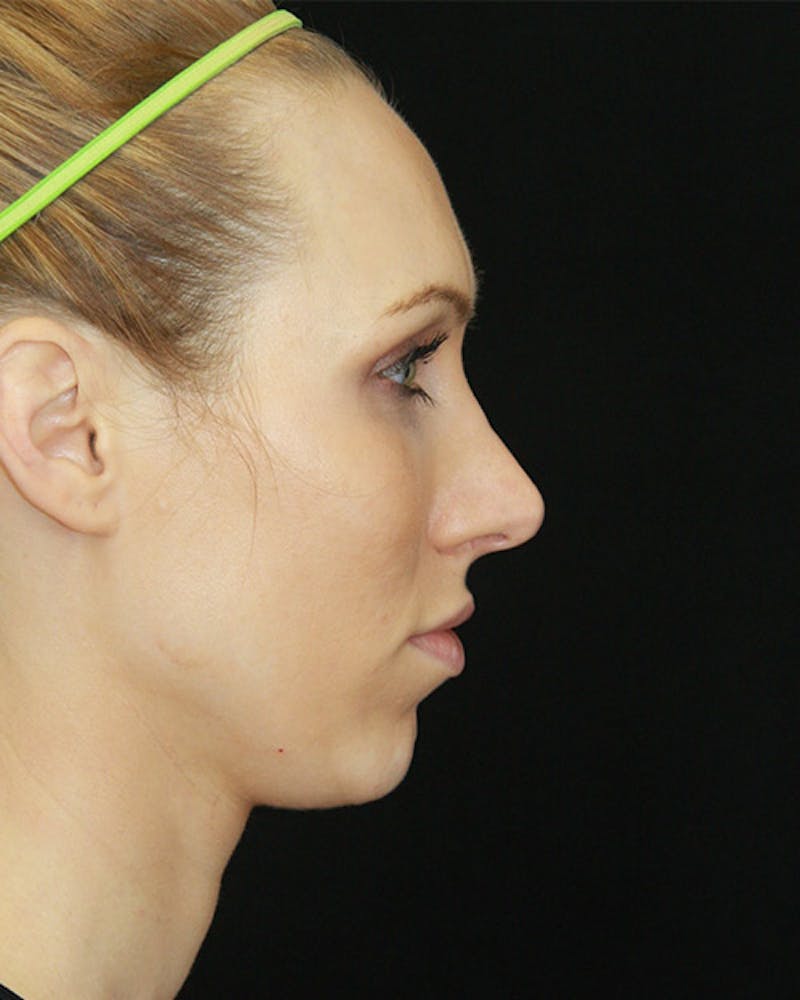 Rhinoplasty Before & After Gallery - Patient 143521940 - Image 5
