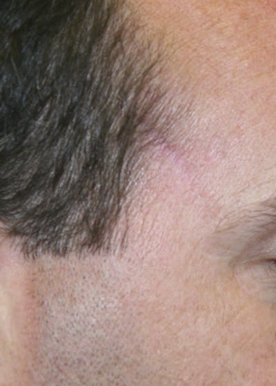Mohs Reconstruction Before & After Gallery - Patient 143521934 - Image 2