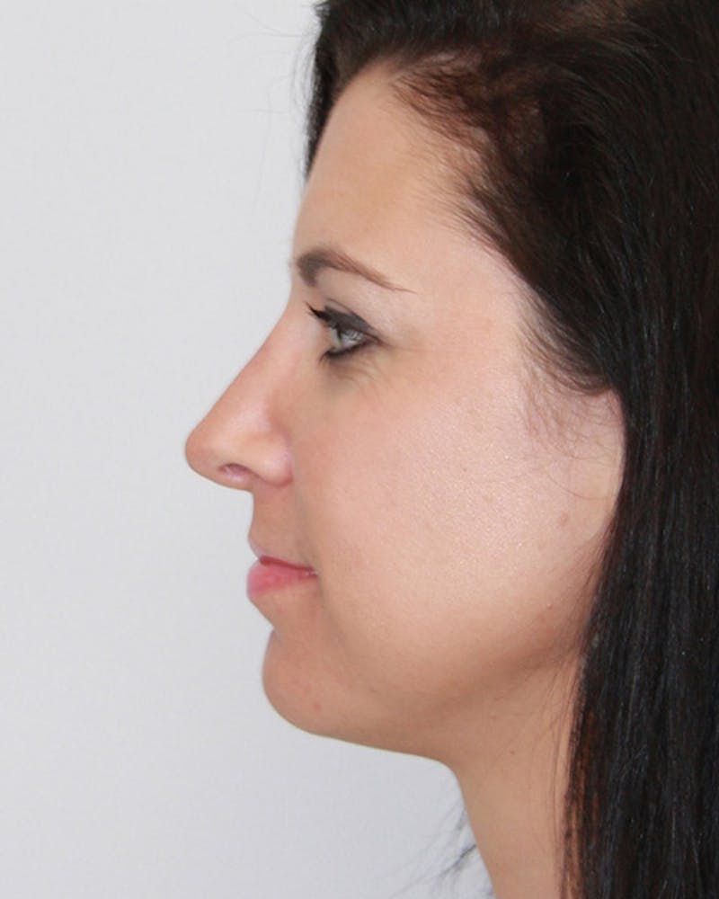 Revision Rhinoplasty Before & After Gallery - Patient 143521935 - Image 8