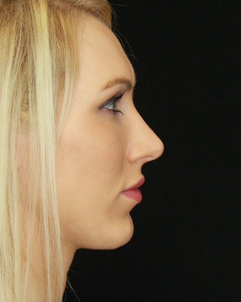 Rhinoplasty Before & After Gallery - Patient 143521940 - Image 6