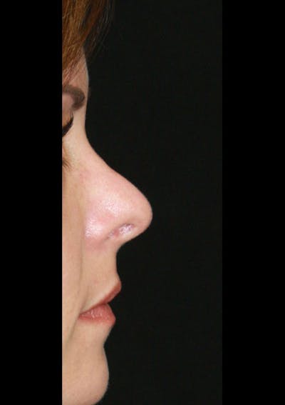 Non-Surgical Rhinoplasty Before & After Gallery - Patient 143521938 - Image 1