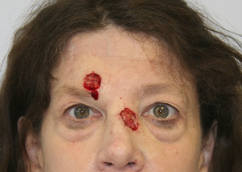Mohs Reconstruction Before & After Gallery - Patient 143521937 - Image 1