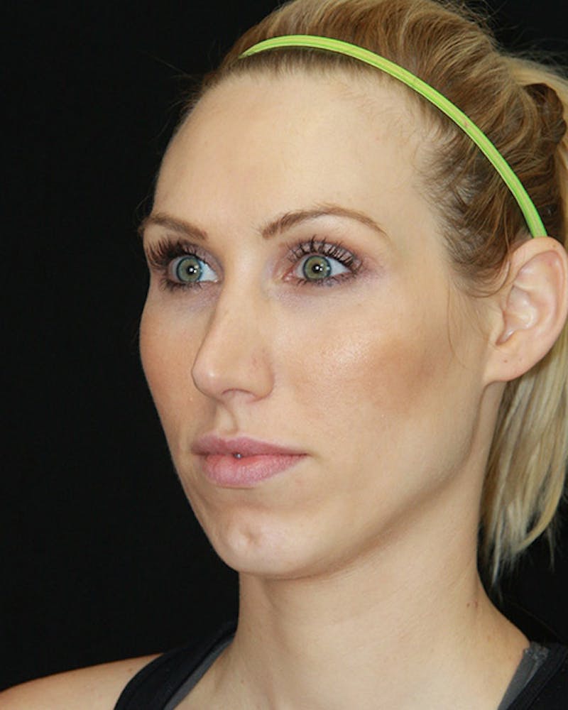 Rhinoplasty Before & After Gallery - Patient 143521940 - Image 7