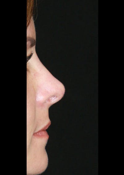 Non-Surgical Rhinoplasty Before & After Gallery - Patient 143521938 - Image 2