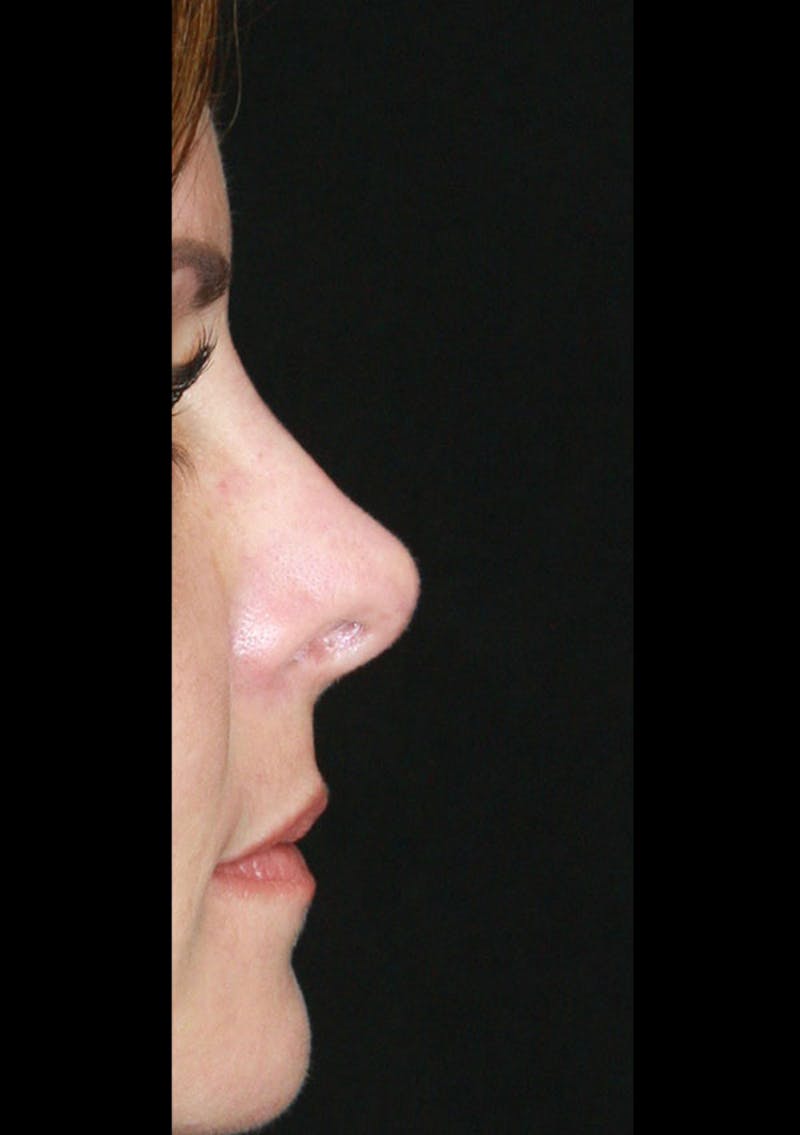 Non-Surgical Rhinoplasty Before & After Gallery - Patient 143521938 - Image 2