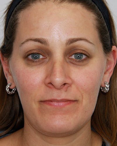 Revision Rhinoplasty Before & After Gallery - Patient 143521951 - Image 1