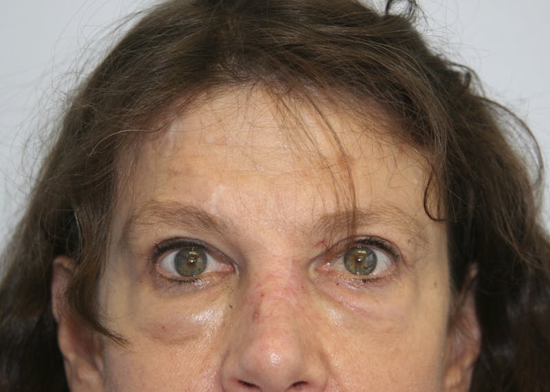 Mohs Reconstruction Before & After Gallery - Patient 143521937 - Image 2