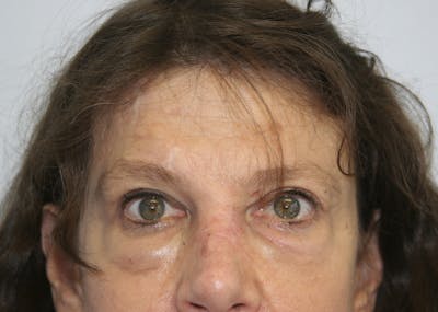 Mohs Reconstruction Before & After Gallery - Patient 143521937 - Image 2