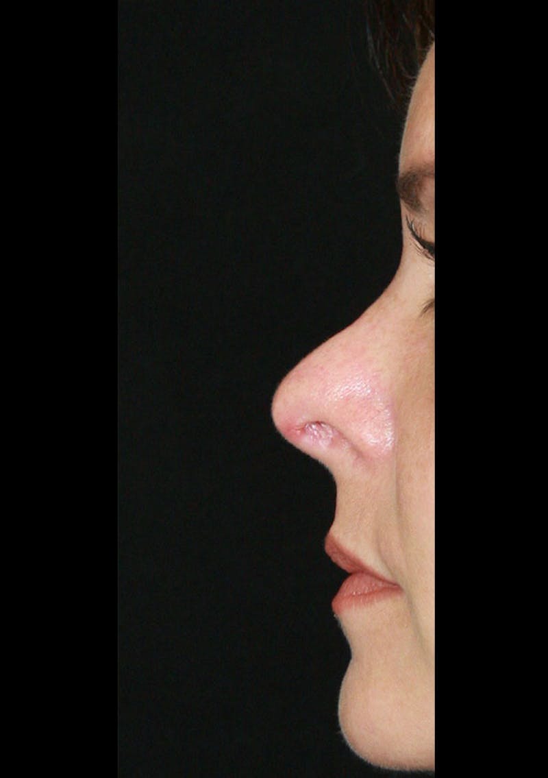 Non-Surgical Rhinoplasty Before & After Gallery - Patient 143521938 - Image 3