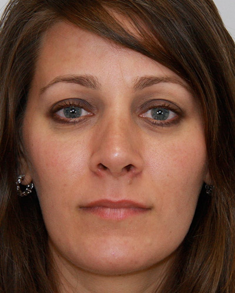 Revision Rhinoplasty Before & After Gallery - Patient 143521951 - Image 2