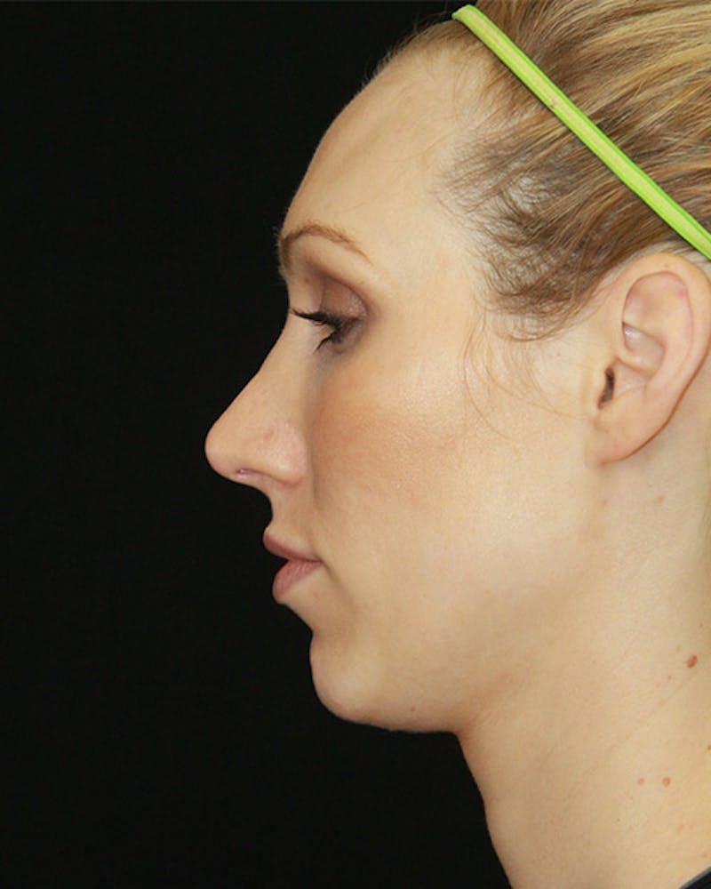 Rhinoplasty Before & After Gallery - Patient 143521940 - Image 9