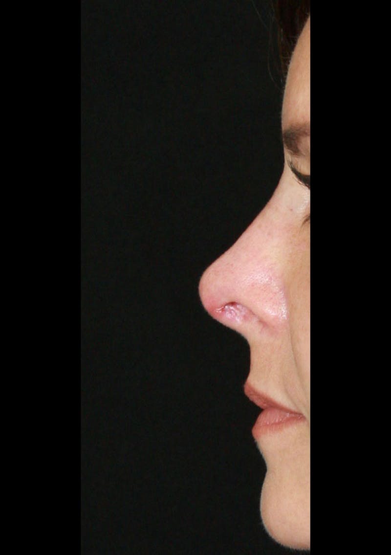 Non-Surgical Rhinoplasty Before & After Gallery - Patient 143521938 - Image 4