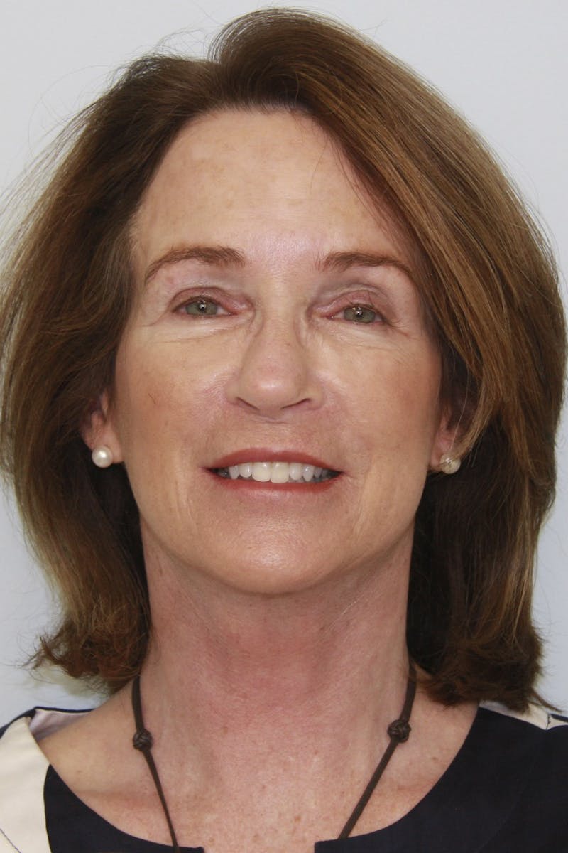 Facelift & Neck Lift Before & After Gallery - Patient 143521955 - Image 2