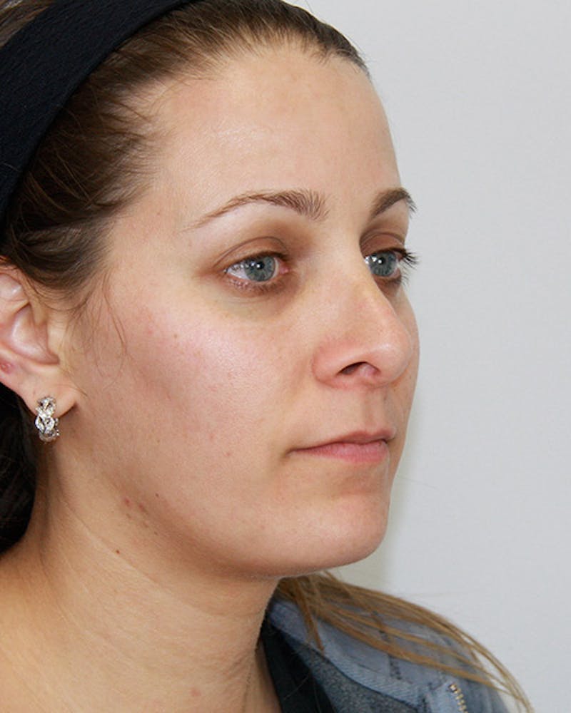 Revision Rhinoplasty Before & After Gallery - Patient 143521951 - Image 3