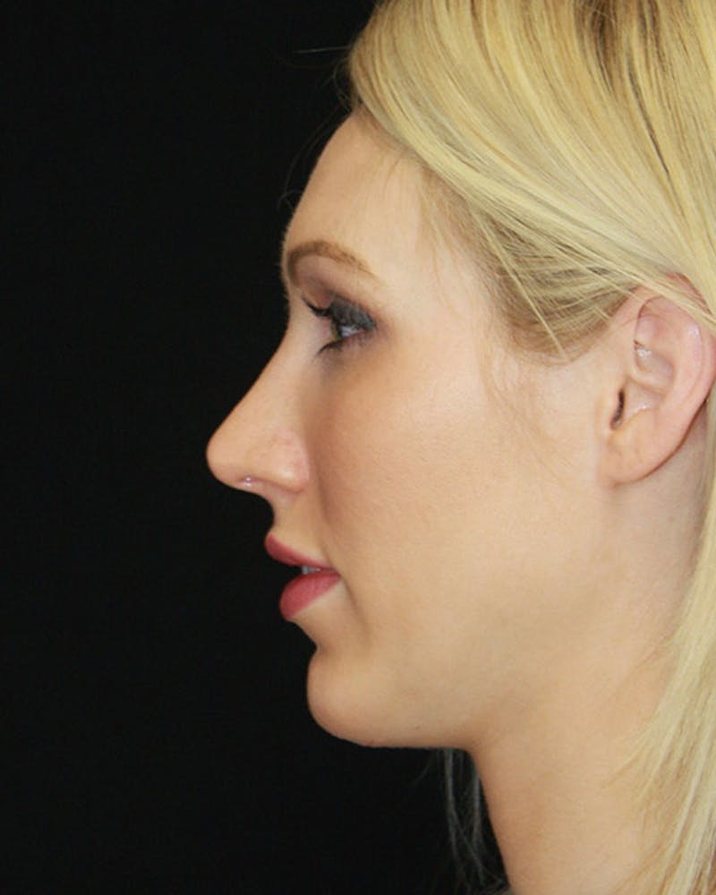 Rhinoplasty Before & After Gallery - Patient 143521940 - Image 10