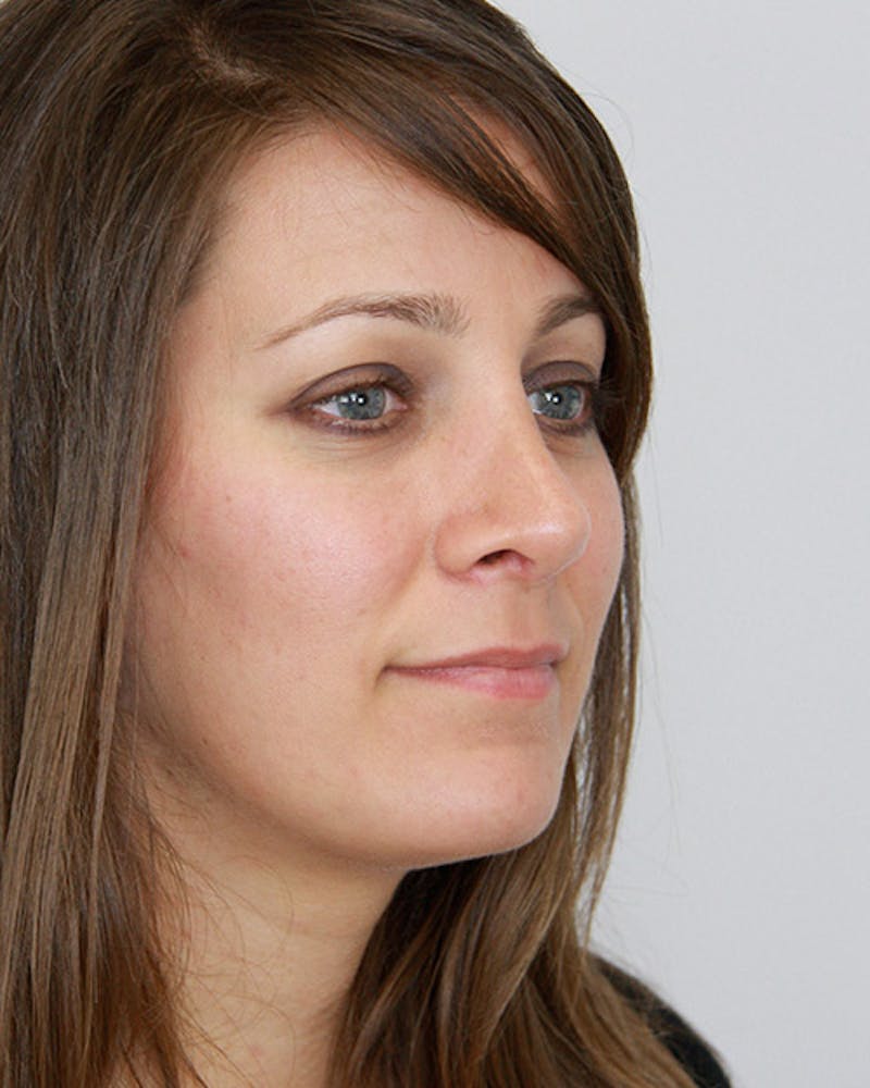 Revision Rhinoplasty Before & After Gallery - Patient 143521951 - Image 4