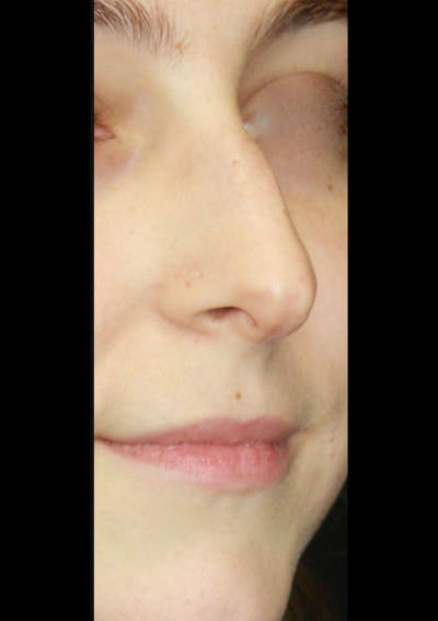Non-Surgical Rhinoplasty Before & After Gallery - Patient 143521942 - Image 1