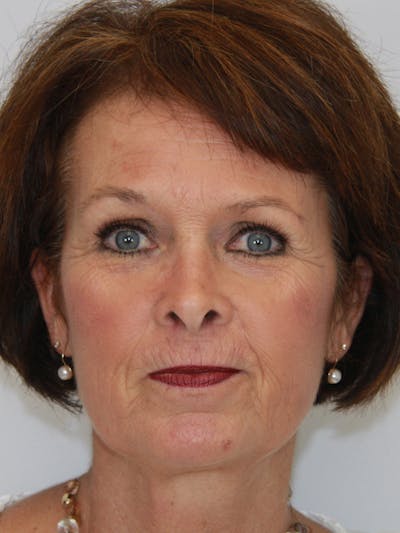 Eyelid Surgery Before & After Gallery - Patient 143521959 - Image 1