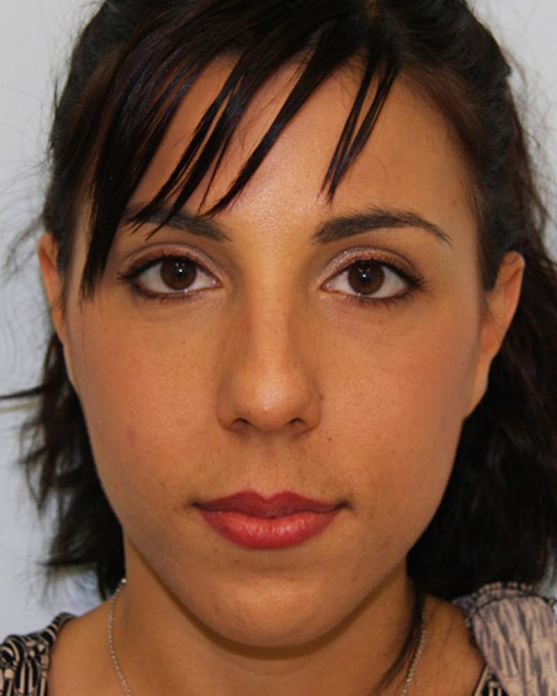 Rhinoplasty Before & After Gallery - Patient 143521950 - Image 1
