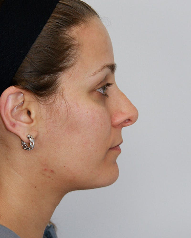 Revision Rhinoplasty Before & After Gallery - Patient 143521951 - Image 5